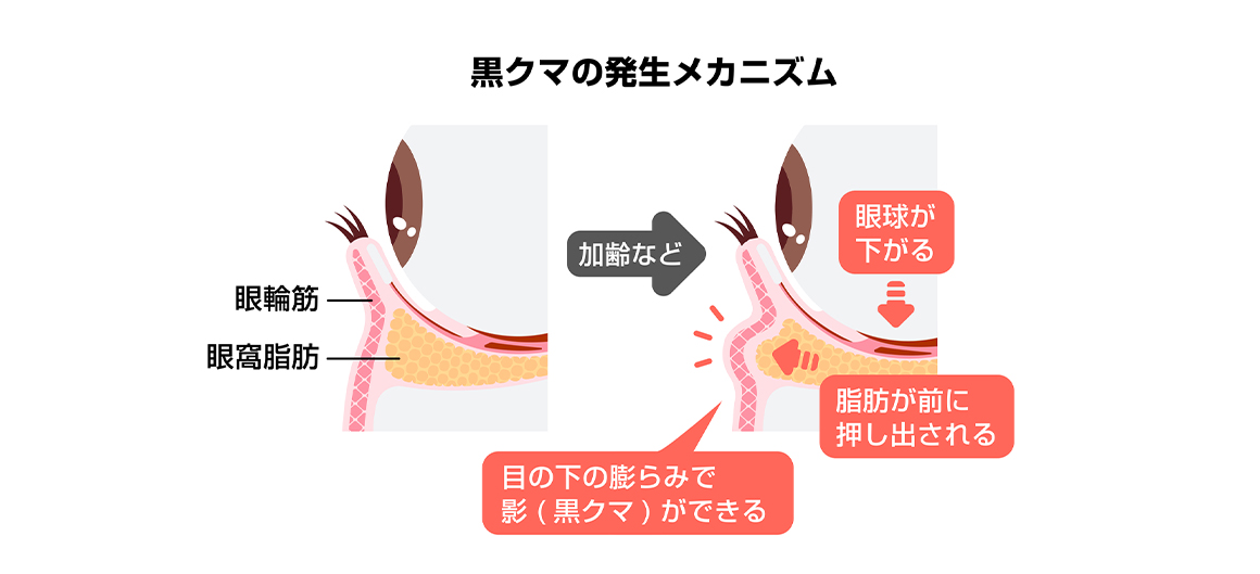 黒クマの発生メカニズム