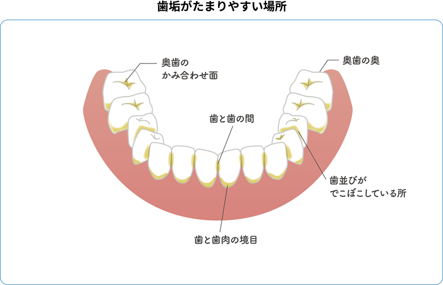 歯垢が溜まりやすい場所