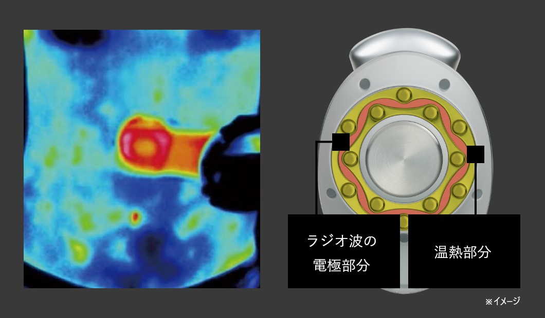 平行電極ヘッド