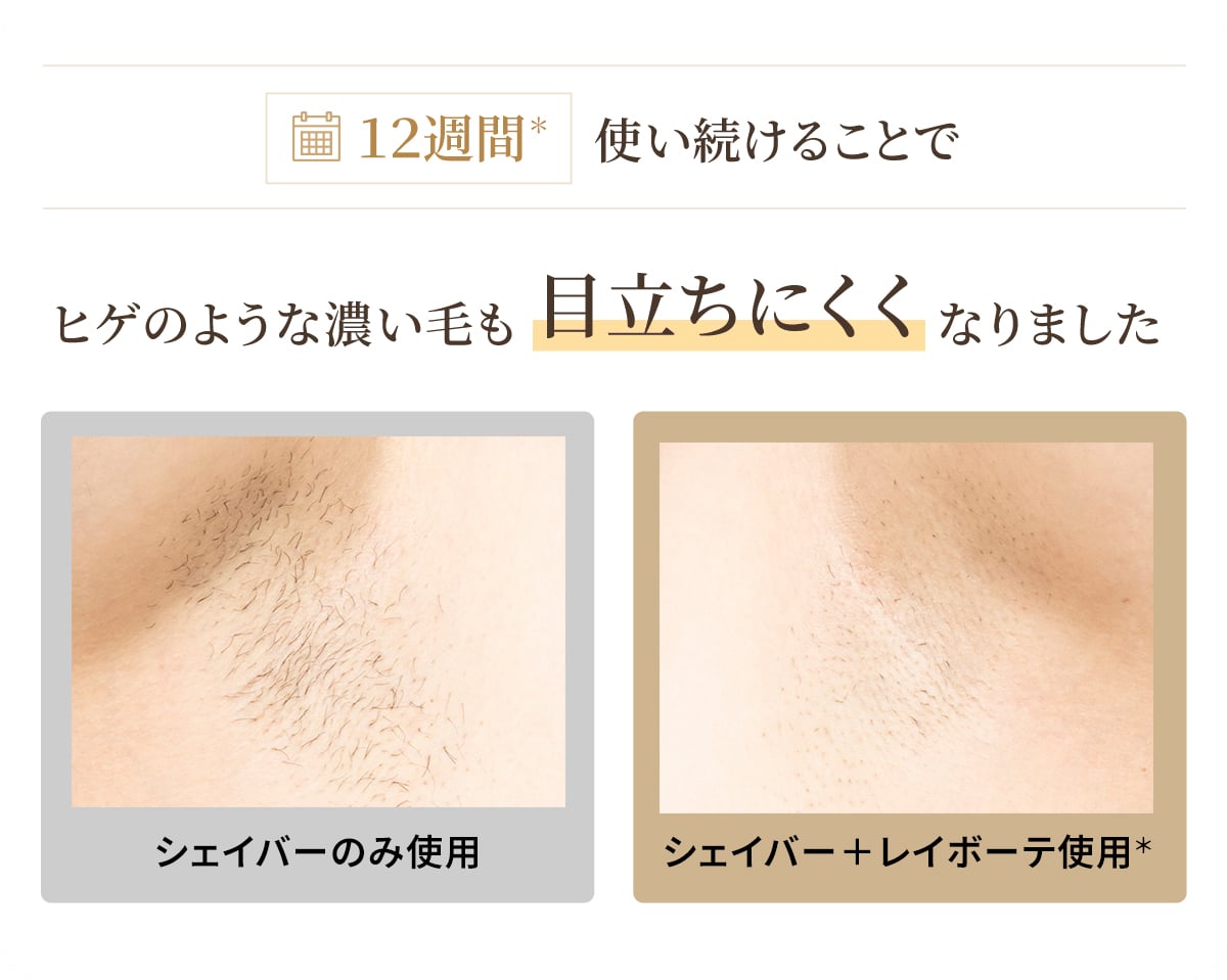 ヒゲのような濃い毛も目立ちにくくなりました